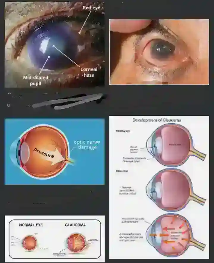 Eye Problems