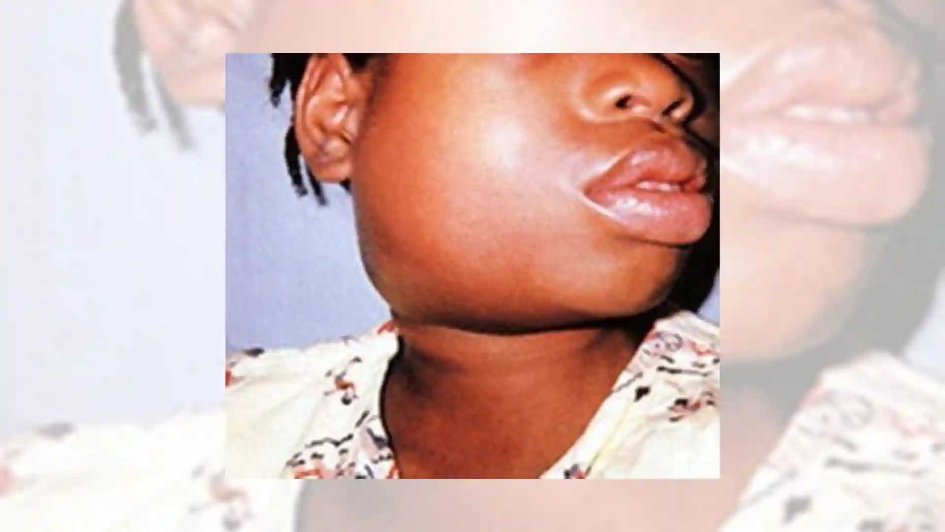 What You May Need To Know About Mumps/Mahumunya/Amatitiyane