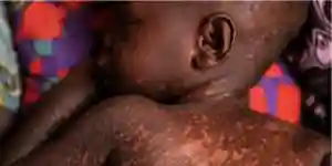 Zimbabwe Measles Outbreak Report: 5 September 2022